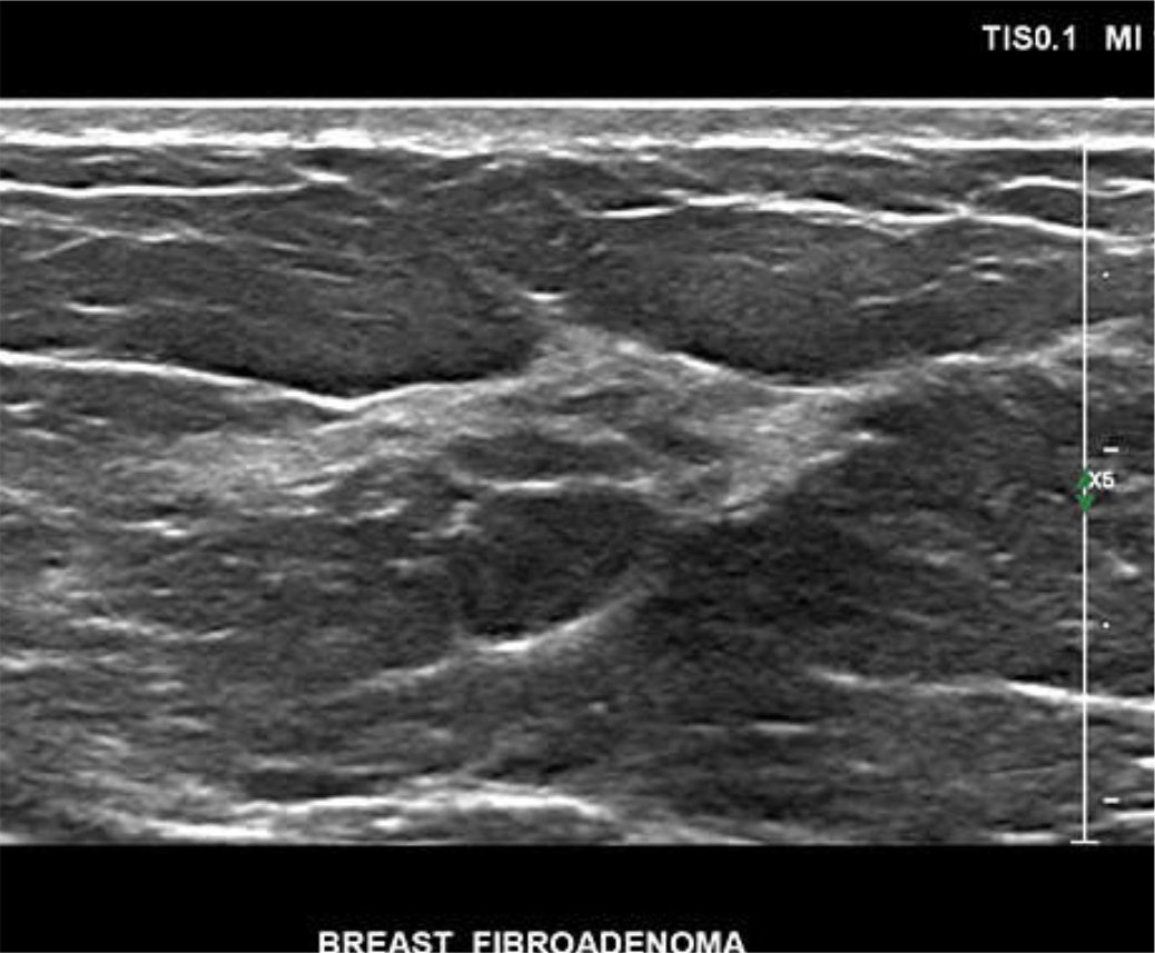 SONOMAMMOGRAPHY (BREAST SONOGRAPHY)